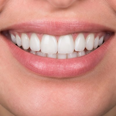 Aesthetic / Cosmetic Dental Fillings